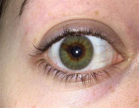 I have a brown line through the green of my eye also known as sectoral ...