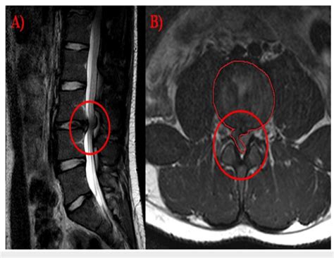 Pre-operative MRI (A) Sagittal T2 MRI showing disc extrusion at the ...