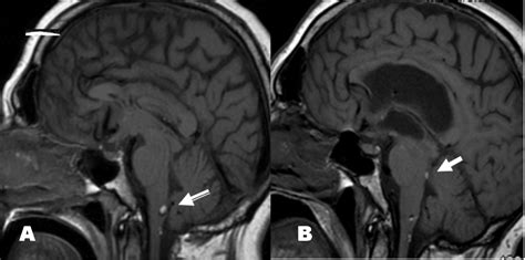 FULL TEXT - Non-communicating hydrocephalus decades after spinal ...