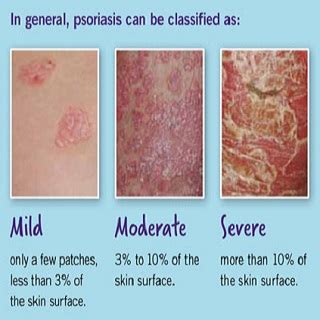 About psoriasis - Site info