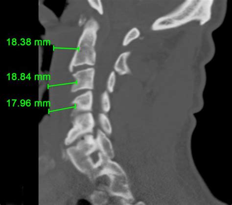 CT scan of cervical spine (Patient 4) showing an increase in the ...