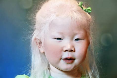 What is Albinism? | Strive For Good Health