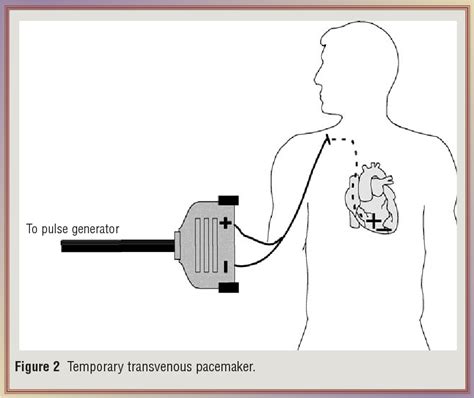 [PDF] Mastering temporary invasive cardiac pacing. | Semantic Scholar