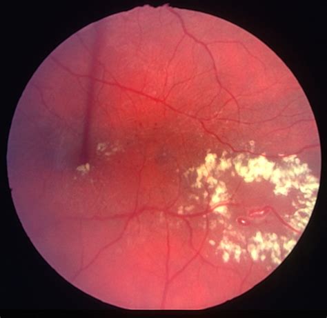 Macular aneurysmal telangiectasia - Retina Image Bank