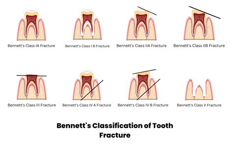 Bennett's Classification of Tooth Fracture - Dental Dictionary