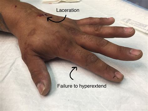 Extensor Tendon Injuries, Part II – Closing the Gap