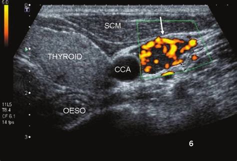 Normal Parathyroid Gland Ultrasound