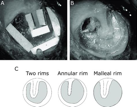 TM before and after perforation. (A) TM with 1 mm paper patches applied... | Download Scientific ...