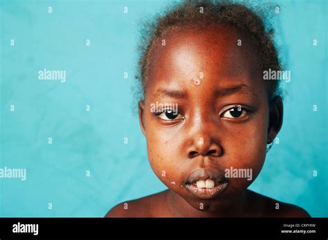 Sickle cell anemia hi-res stock photography and images - Alamy