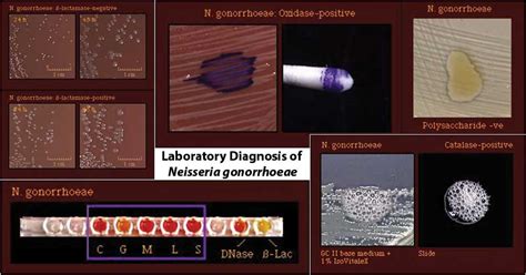 Neisseria gonorrhoeae- Laboratory Diagnosis, Treatment, Prevention