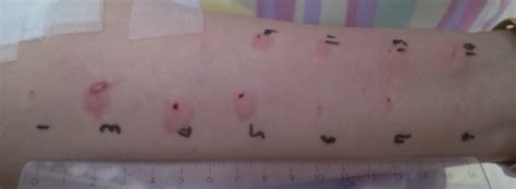 Intradermal tests with various antihistamines. Wheal and flare reaction ...