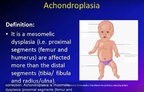 Achondroplasia — OrthopaedicPrinciples.com