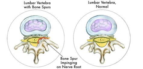 What Causes Bone Spurs or Osteophytes? | Bonati Spine Institute