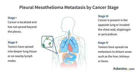 Mesothelioma Metastasis: Risk Factors, Symptoms & Treatment