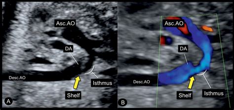 Coarctation of the Aorta and Interrupted Aortic Arch | Obgyn Key