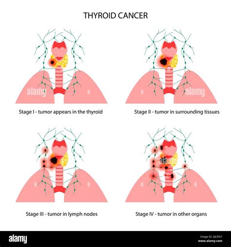 Thyroid cancer stages, illustration Stock Photo - Alamy