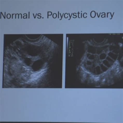 Normal Vs Polycystic Ovaries Ultrasound