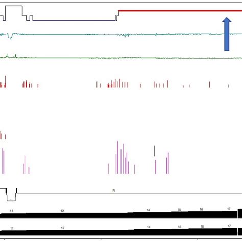 Analysis of the nocturnal polysomnography during manual titration. From... | Download Scientific ...