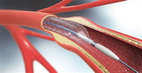 Drug-eluting stents perform better than bare metal - Hospital Pharmacy EuropeHospital Pharmacy ...