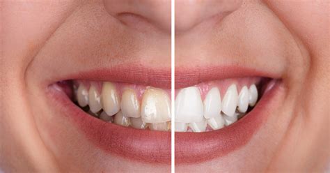 Is Tooth Whitening Bad for My Teeth? | Mint Hill Dentistry