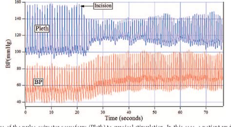 Photoplethysmography | Semantic Scholar