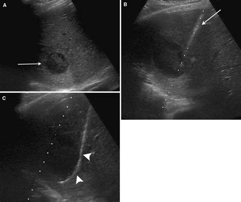 Liver Abscess Ultrasound