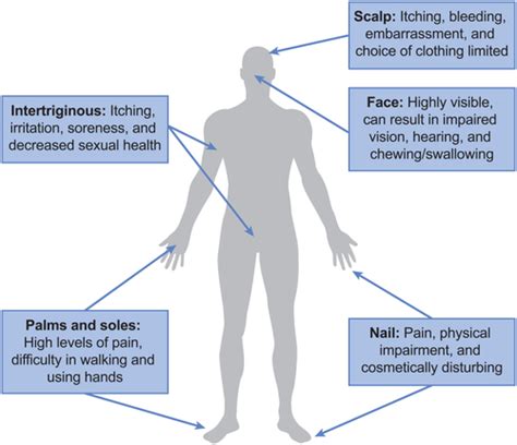 Underdiagnosed and undertreated psoriasis: Nuances of treating psoriasis affecting the scalp ...