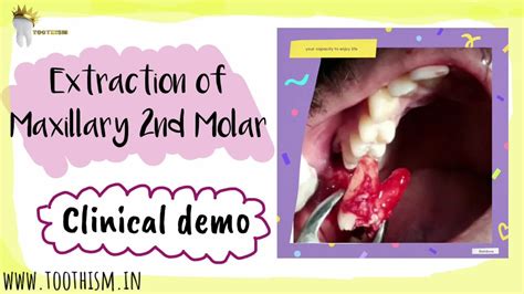 CLINICAL DEMO OF EXTRACTION OF MAXILLARY 2ND MOLAR - YouTube