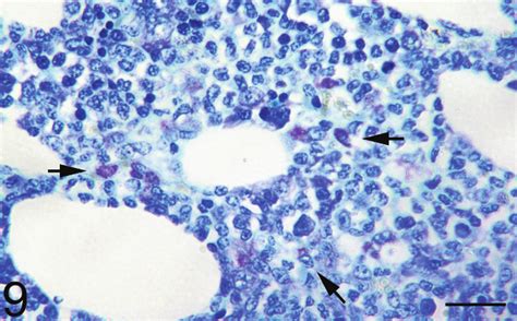 Neoplastic mast cells with metachromatic cytoplasmic granules... | Download Scientific Diagram