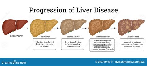 Stages Of Liver Damage. The First Symptoms Of Liver Problems Are Abdominal Pain, Swollen Belly ...