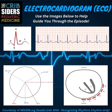 Hypocalcemia Ekg