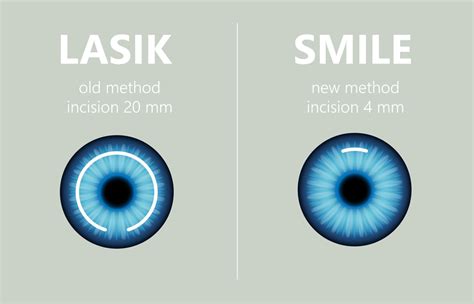 ReLEx Smile Eye Surgery in Delhi: Best Doctors, Cost & Hospital