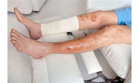 'Early warning' tool for hard-to-heal leg wounds