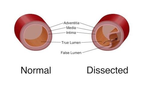 Aortic dissection - UF Health