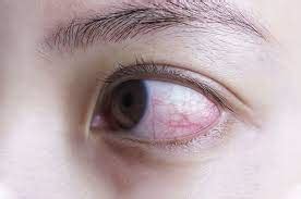 Bagaimana Jika Retina Mata Rusak, Apakah Bisa Sembuh? – National Eye Center