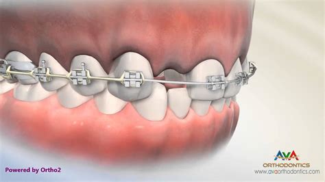 Missing Lateral Incisor - Treatment Options - Orthodont... | Doovi