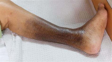 Leg discoloration. El Paso I&I Specialists Vascular experts. 915-260-6902