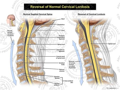 Cervical Paraspinal Muscle Spasm | tunersread.com