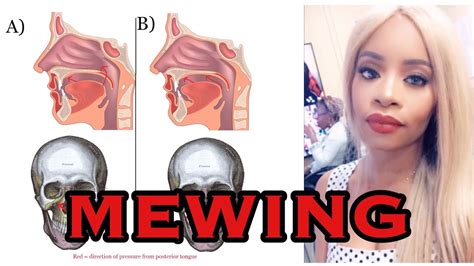 Mewing Tongue Posture Diagram