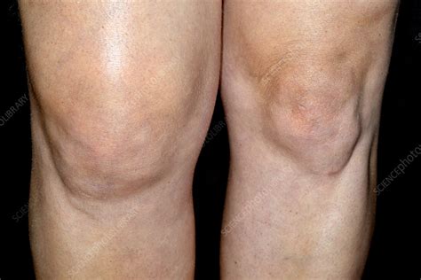 Swollen knee - Stock Image - C026/3365 - Science Photo Library