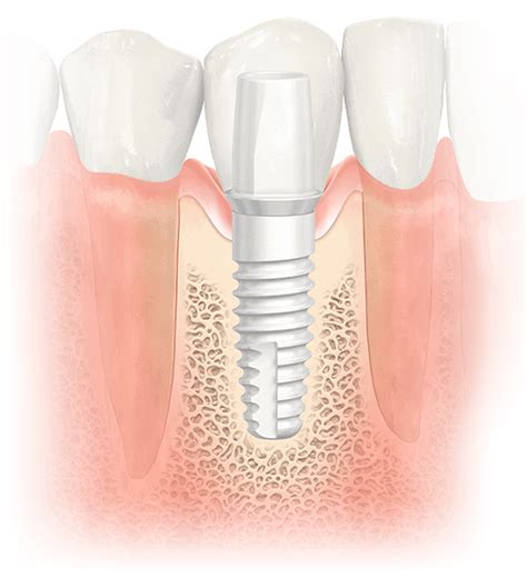 NoblePearl Dental Implant