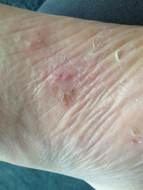 Is this eczema on the bottom of my foot? : r/eczema