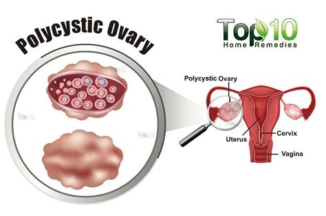 Home Remedies for Polycystic Ovary Syndrome (PCOS) | Top 10 Home Remedies