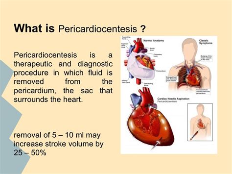 Pericardiocentesis