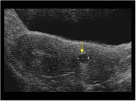 Gynaecology | 3.1 Uterus : Case 3.1.2 Miscellaneous benign uterine and ...