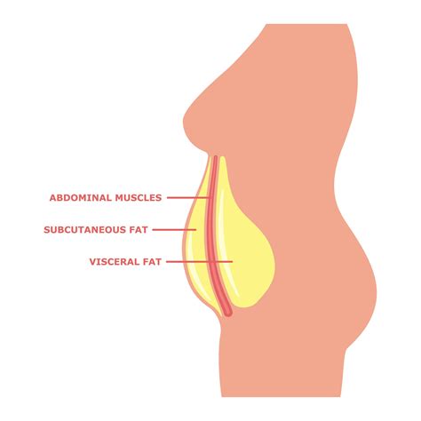 Visceral Fat Vs. Subcutaneous Fat: Will Lipo Help Either?