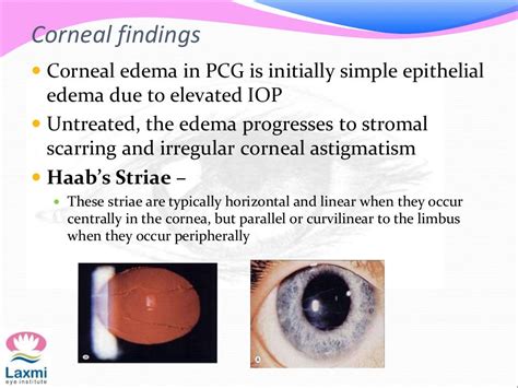 Congenital glaucoma