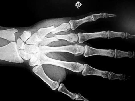Metacarpal Fracture Treatment in Raleigh NC by Dr. Erickson