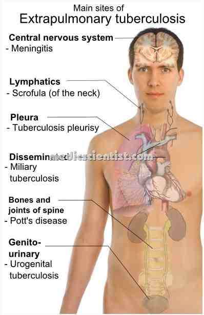 EXTRA PULMONARY TUBERCULOSIS Diagnosis Signs and Symptoms with ...