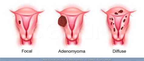 Adenomyosis - Symptoms, Causes, Diagnosis & Treatment